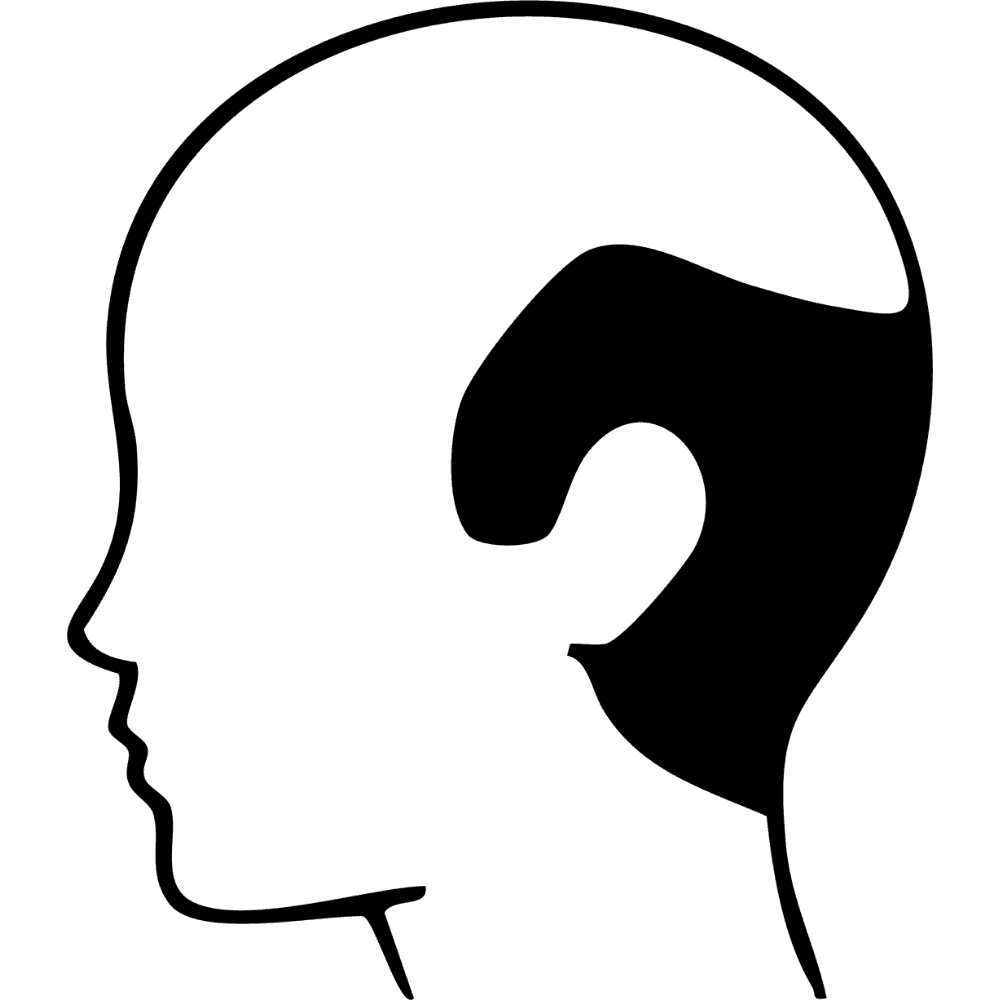 LIVELLO V — Calvizie più estese