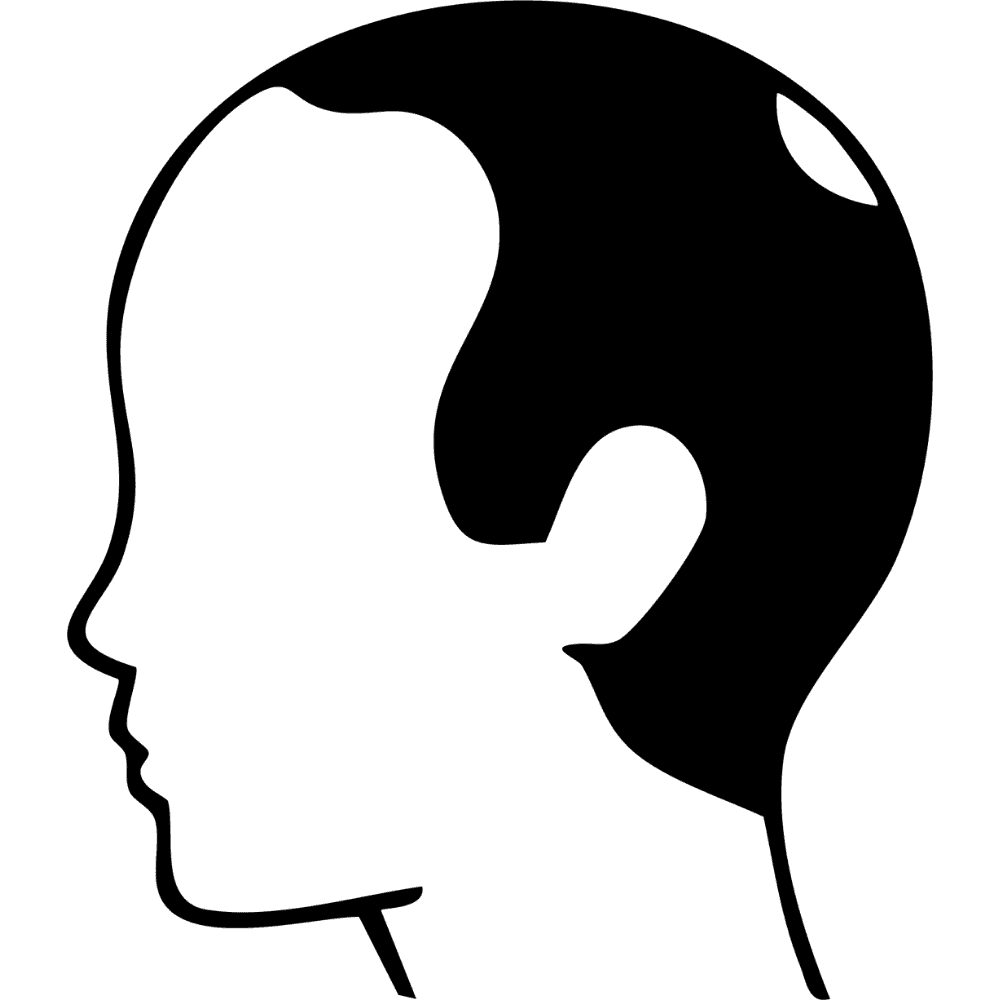 LIVELLO VII — Calvizie avanzata e completa